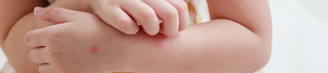 Dermatitis Numularis