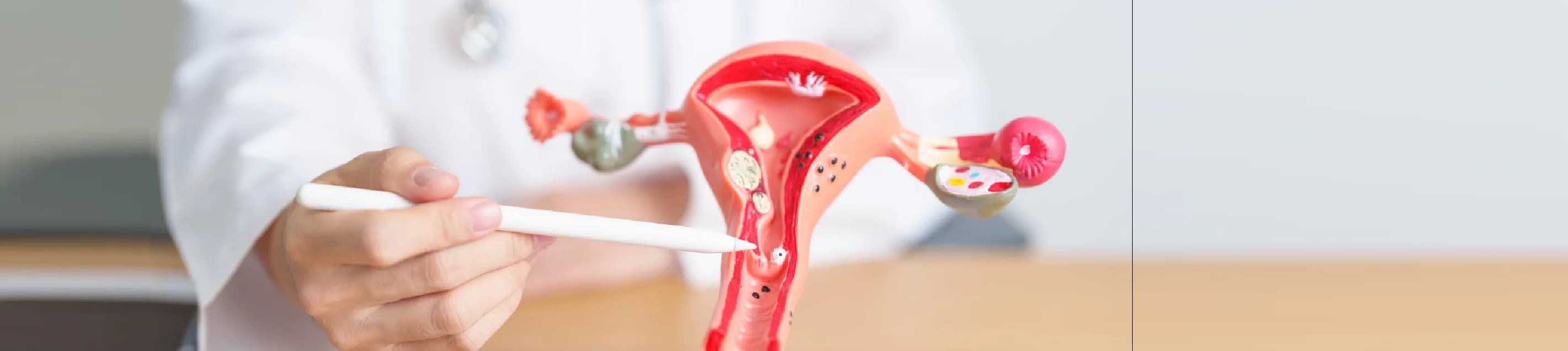 Kanker Serviks (Kanker Leher Rahim)