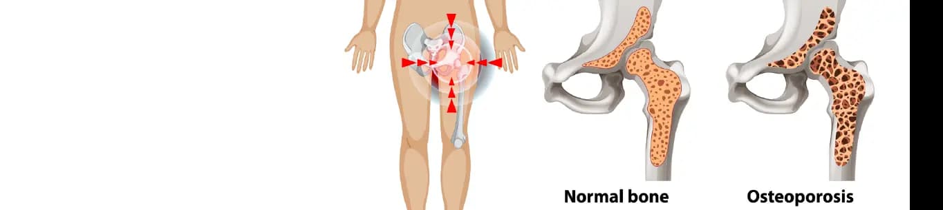 Osteoporosis pada Usia Produktif